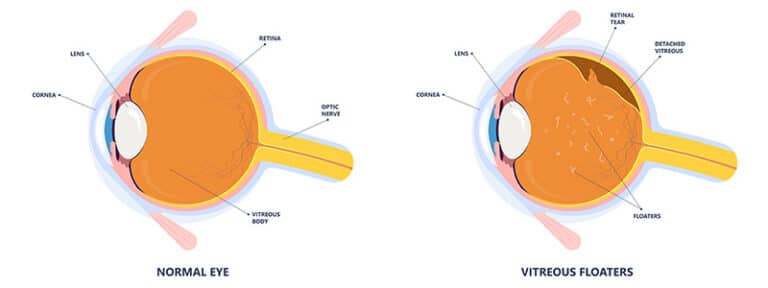 Eye Floaters and Flashes - Coastal Vision Center